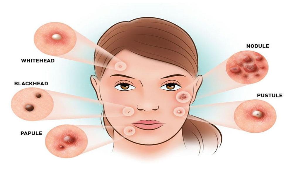 5 signs of adult Hormonal Acne and their root causes